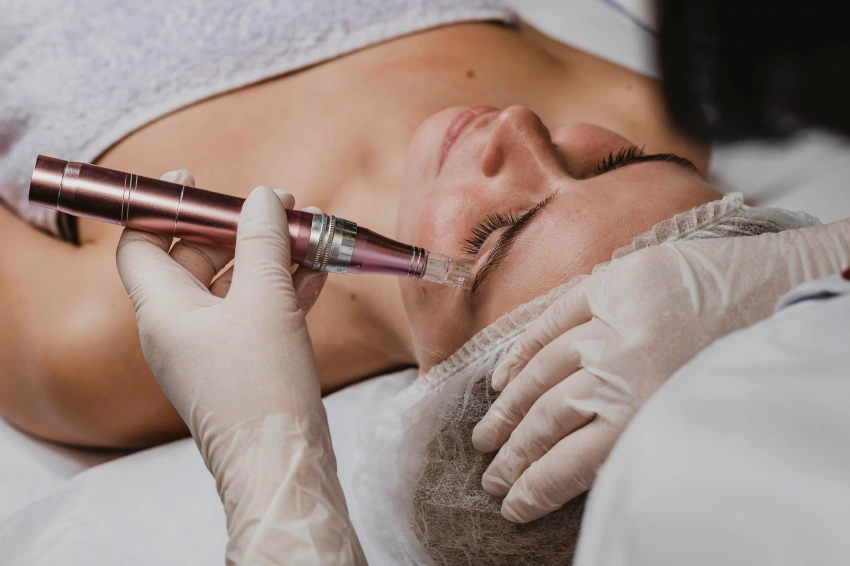 Microneedling for Acne Scars | Complete Guide & Benefits — PALMS Day Spa blog